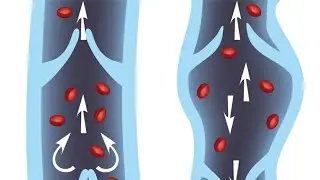 Варикозное расширение вен. Видео N 3.