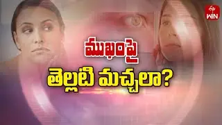 Treatment modalities for white spots on face and skin | Sukhibhava 6th Sep 2024 | ETV Life