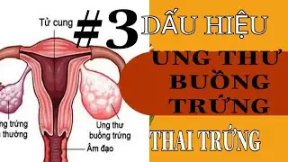 dau hieu nhan biet ung thu buong trung thai trung MOP CHANNEL
