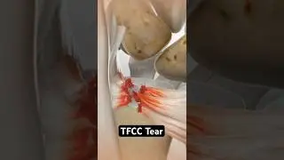 Wrist pain could be a tear (3D Animation)
