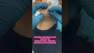 Subcision & FractionalCO2laser treatment for chicken Pox Scars| open pores|acne scars