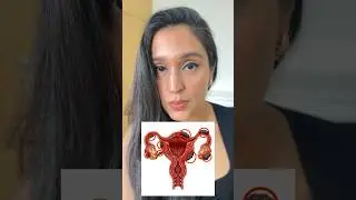 My battle with ENDOMETRIOSIS | PART 1 #endometriosis #endometriosisawareness