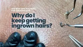 Why do I keep getting ingrown hairs? Say no to Razor Bumps, Irritation and Dark Spots!