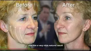 Facelift - Dr. Scott Holley - 59 YO Woman - Case Analysis #beforeafter