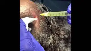 Tratamiento Capilar con Plasma Rico en Plaquetas. Clínica Merced 👨‍⚕️👩‍⚕️