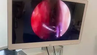 Endoscopic dacryocystorhinostomy silicone stent