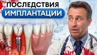 ЧТО может ПОЙТИ НЕ ТАК после ИМПЛАНТАЦИИ зубов? / Самые частые жалобы после операции на зубы