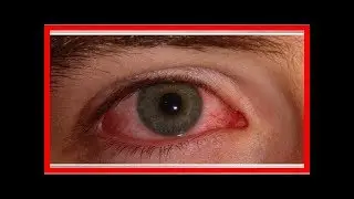 Gerötete Augen – Ursachen und einfache Hausmittel