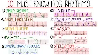 Most Common ECG Patterns You Should Know