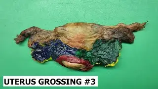 Uterus grossing #3 - cervical cancer