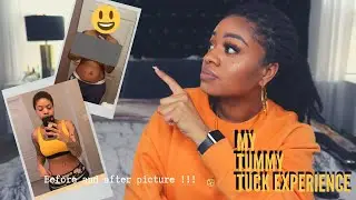 My Tummy Tuck Experience |  Before and After Picture | Alexis Nichole