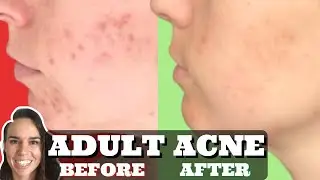 Adult Acne Skincare treatments and serums available in Australia!