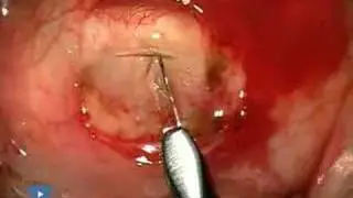 Choroidal Exposure Phaco 3.1 Complications