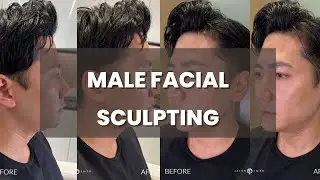 MALE ASIAN FACIAL SCULPTING: JAWLINE AND CHIN CONTOURING FOR A MORE MASCULINE LOOK  | DR JASON EMER