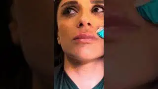 Lip filler treatment - Dr Guncel Ozturk
