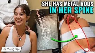 Chiropractic Patient has Severe Scoliosis with Harrington Rods