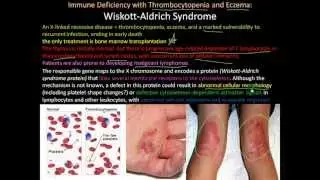 107P   Severe Combined Immunodeficiency, Wiskott Aldrich Syndrome