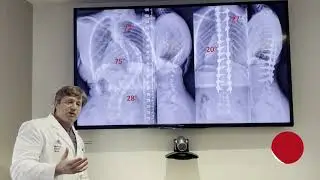 Adolescent idiopathic scoliosis