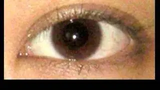 Single 2 Double - Asian Eyelid Surgery