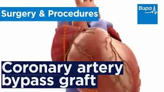How coronary artery bypass graft (CABG) surgery is carried out | Bupa Health