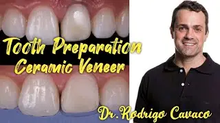 Preparation of teeth for ceramic veneers. Dr.Rodrigo Cavaco