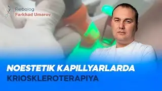 Noestetik kapillyarlarda krioskleroterapiya