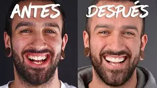 MIS NUEVOS DIENTES