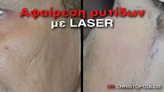 Laser Resurfacing Αφαίρεση Ρυτίδων με laser - Plastic Surgeon