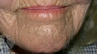 Solar Elastosis & Senile Comedones & Spreading Blackheads