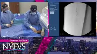 LIVE CASE PRESENTATION #7   SESSIONS IN CLTI  ANTEGRADE TIBIAL REVASCULARIZATION OF SEVERE TIBIAL DI