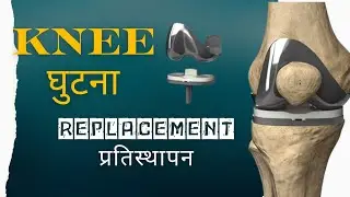 knee arthroplasty no cement | Surgery |