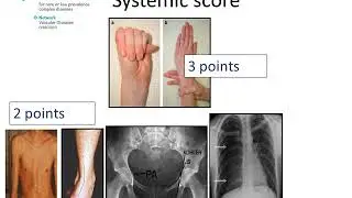 Marfan Syndrome - Diagnosis by Prof Julie De Backer