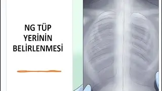 Nazogastirik Tüp (NG) yerinin doğrulanması