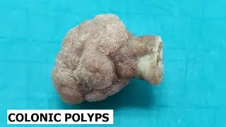 Colonic polyps grossing (polypectomies)