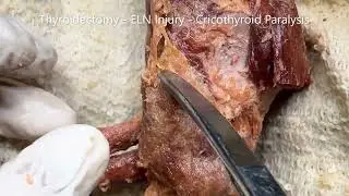 THYROID GLAND LARYNX EXTERNAL ARTERIES LARYNGEAL NERVES and Clinical Correlations – Sanjoy Sanyal