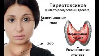 Аутоиммунный тиреоидит. Тиреотоксикоз. Результаты лечения.
