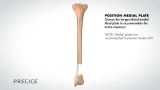 PRECICE Plate Assisted Bone Transport Animation