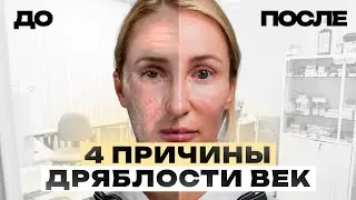 Как избавиться от ДРЯБЛОСТИ век? Топ причин ПТОЗА век