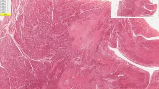Heart - Healed myocardial infarct Microscopy