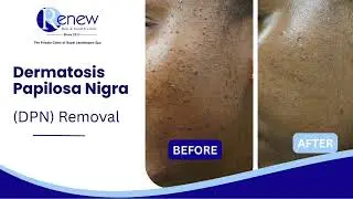 DPN (Dermatosis Papulosa Nigra) Treatment | What to Expect, Patient Results