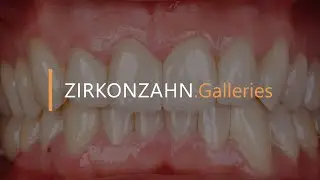 Minimally invasive treatment with Prettau® Skin® ultra-thin veneers | Zirkonzahn.Galleries