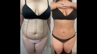 Liposuzione ultrasonica - risultato