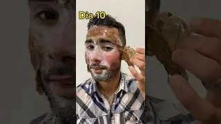 Parte III - Peeling de Fenol Profundo