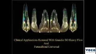 Clinical Tip: How to caulk the window with GrandioSO Heavy Flow