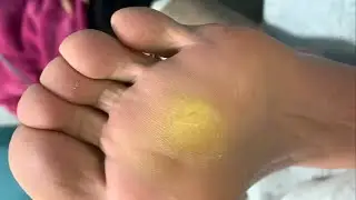 Callus removal from feet&Foot scraping dead skin【TD Foot care】