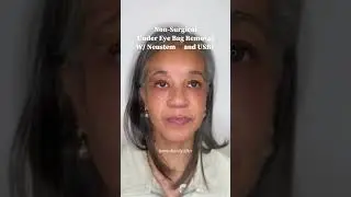 Removal of under eye bags