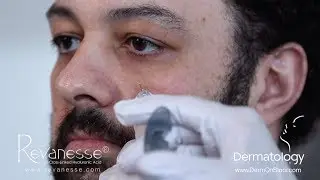 Injectable Fillers For Men