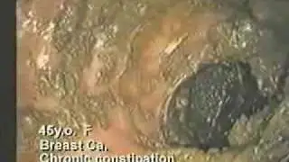 Intestinal Issues, alkaline water will flush them AWAY