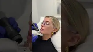 Coolaser® Skin Resurfacing
