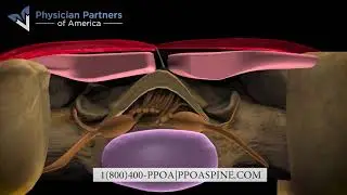 Laser Spine Procedure - Facet Joint | PPOA